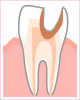 神経まで進んだ虫歯（C3）